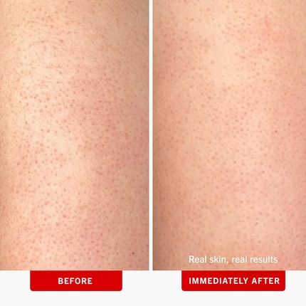 First Aid Beauty Kp Bump Eraser Body Scrub With 10% Aha For Keratosis Pilaris - Image 3