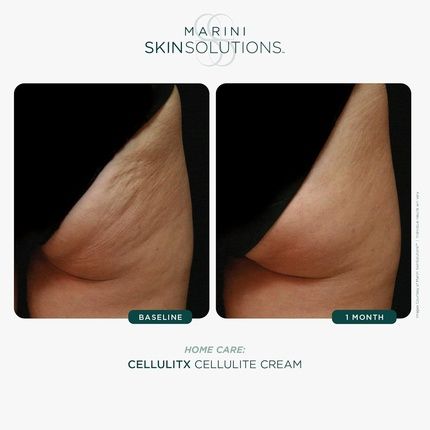 Marini Skinsolutions Cellulitx Cellulite Thigh Cream With Aminophylline