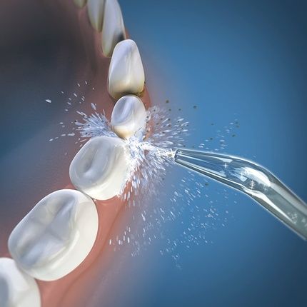 Waterpik Whitening Water Flosser Replacement Classic Jet Tips - Image 3