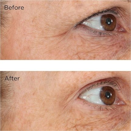 Perricone Md Eyelid Lift Serum - Image 3