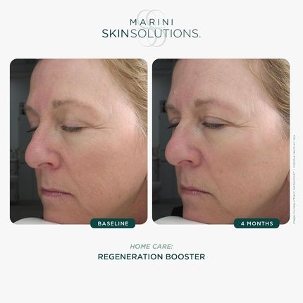 Regeneration Booster