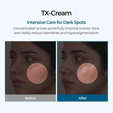 Tx Tranexamic Acid Cream For Skin Freckles And Blemishes