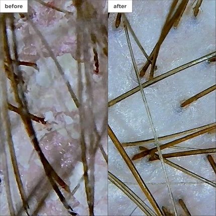 Briogeo Antidandruff Shampoo With Salicylic Acid For Dry Scalp 248Ml - Image 3