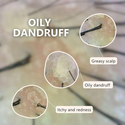 Aromase Dandruff Shampoo For Men Clarifying Shampoo For Oily Scalp - Image 3