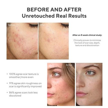Murad Invisiscar Resurfacing Treatment For Reducing Acne Scars And Dark Spots 1 Fl Oz - Image 3