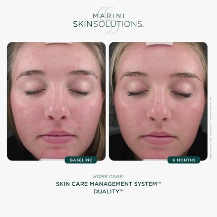 Marini Skinsolutions Duality Benzoyl Peroxide 10 Acne Treatment Cream