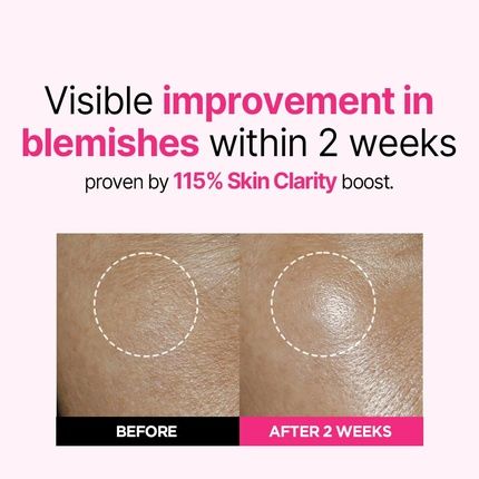 Isoi Blemish Care Up Serum Vegan Hydrating Serum For Smooth & Glass Skin