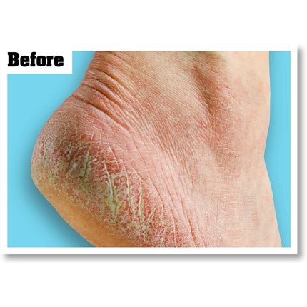 O'Keeffe'S Healthy Feet Foot Cream For Extremely Dry Cracked Feet 85G - Image 3
