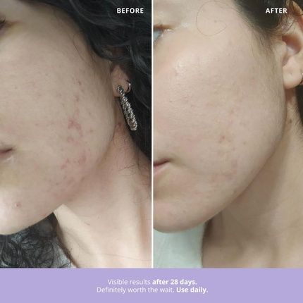 Freshly Cosmetics Acne And Reactive Skin Facial Treatment 100% Natural Azelaic Radiance 50Ml - Image 3