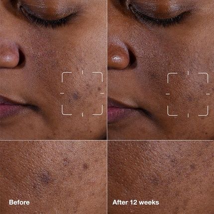 Clinique Even Better Clinical Dark Spot Clearing Serum With Vitamin C