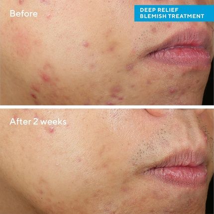 Murad Deep Relief Blemish Treatment Max Strength 2% Salicylic Acid For Cystic Acne