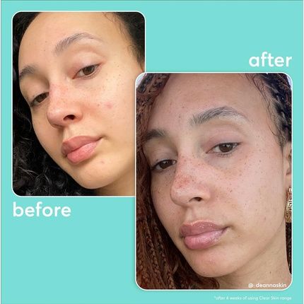 Super Facialist Pore-Fect Daily Moisturiser Hydrate & Control Oil For Acne Treatment & Blackhead Remover With 3% Niacinamide, Tea Tree Oil & Prebiotics Vegan Friendly 75Ml - Image 3