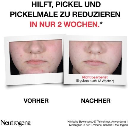 Neutrogena Anti-Pimples + Daily Serum 30Ml Skin Clarifying Face Serum With Cleansing Salicylic Acid And 10% Aha/Pha Blend Facial Care Serum Against Disturbing And Stubborn Pimples White - Image 3