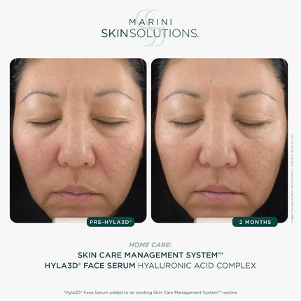 Marini Skinsolutions Hyla3D Face Serum Patented Hyaluronic Acid Complex