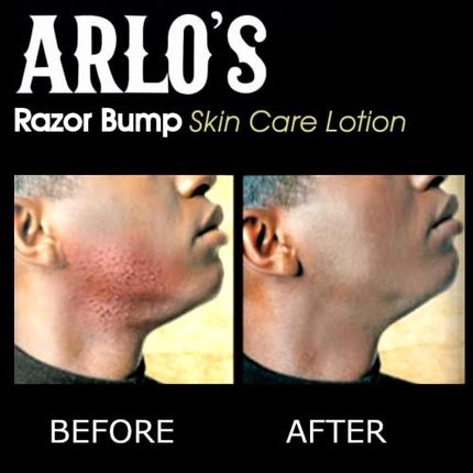 Arlo'S Razor Bump Skin Care Lotion 6 Oz.